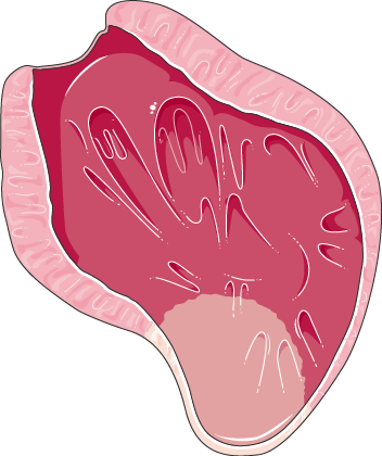 Myocardial infarction