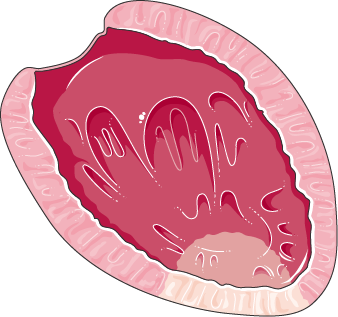 Myocardial infarction