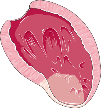 Myocardial infarction
