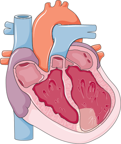 Myocardial infarction