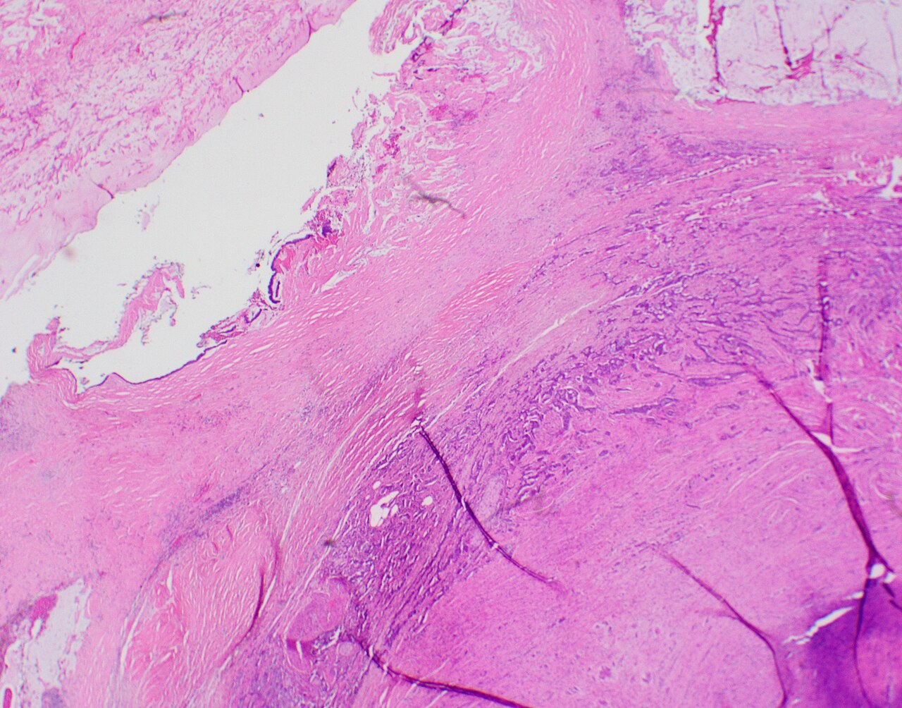 Neoplasm