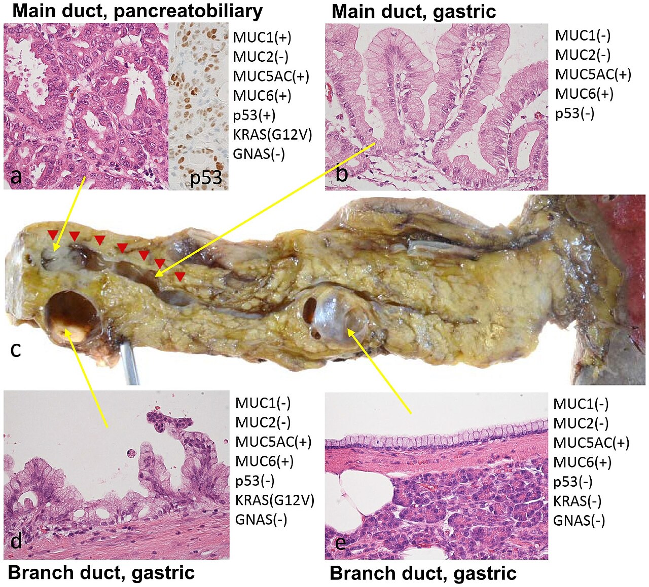 Neoplasm