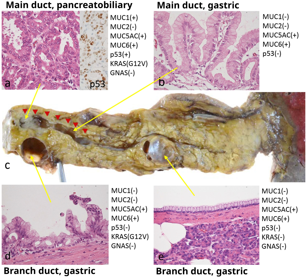 Neoplasm