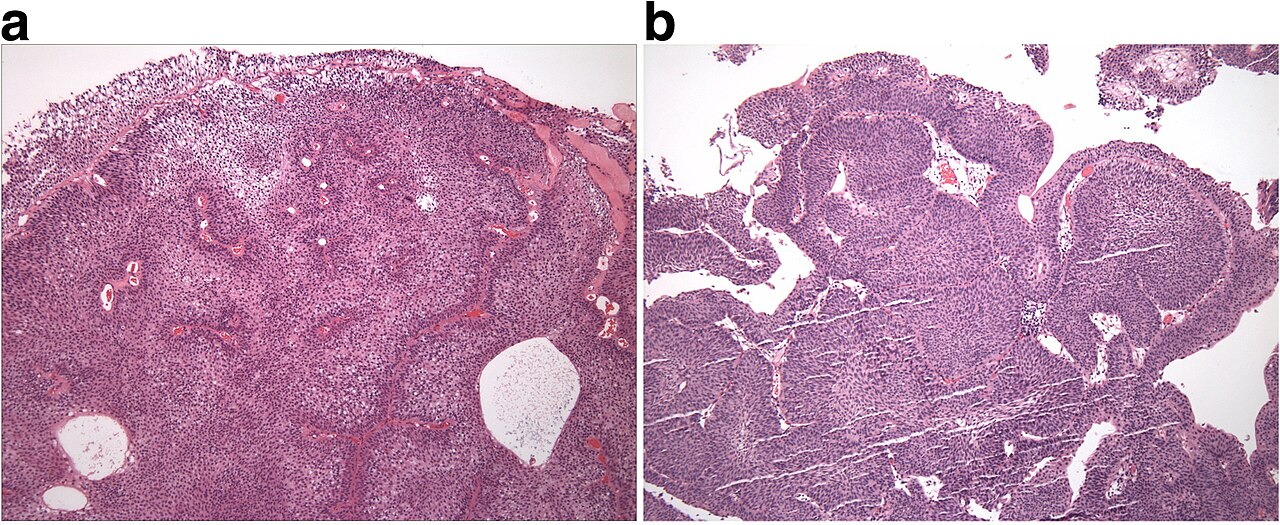 Neoplasm