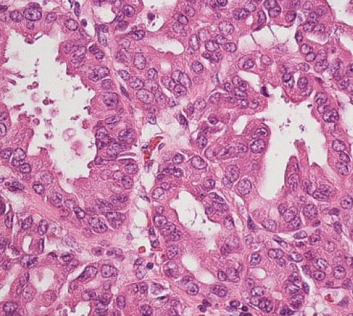 Neoplasm