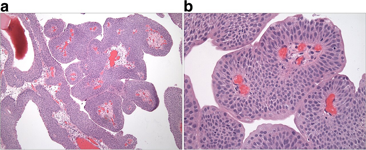 Neoplasm