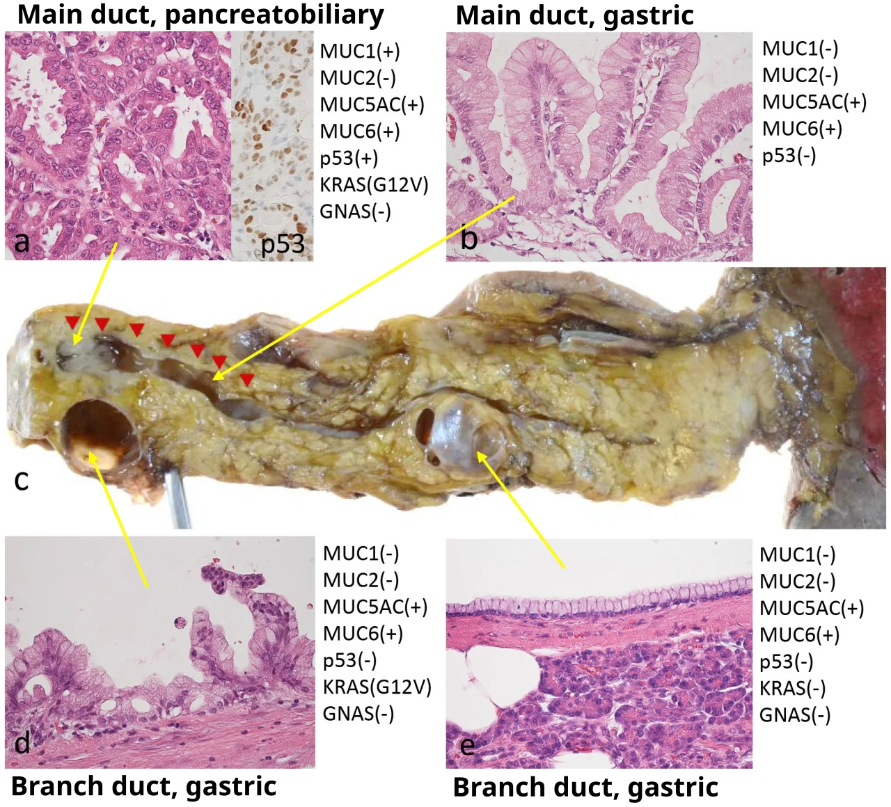 Neoplasm