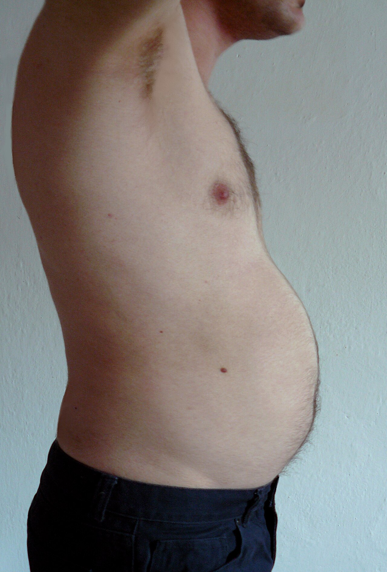 Obesity