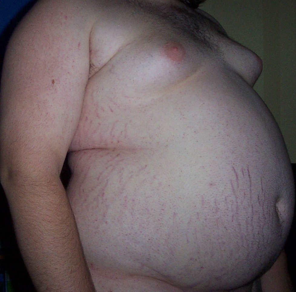 Obesity