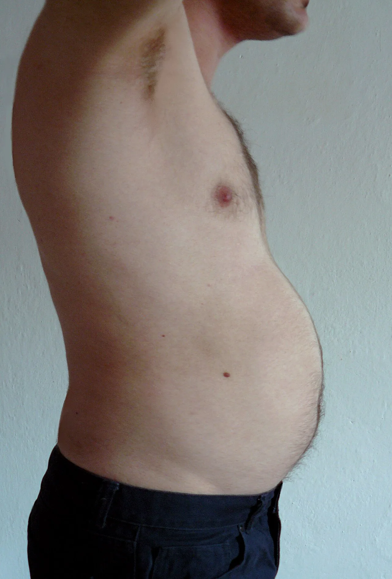 Obesity