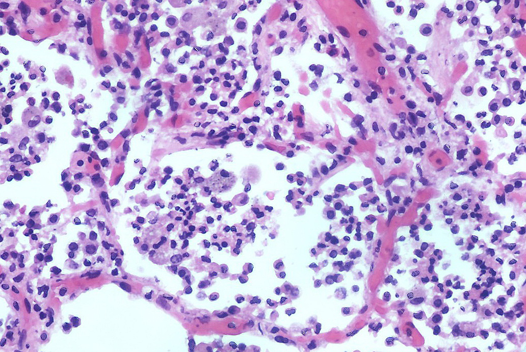 Pneumonia