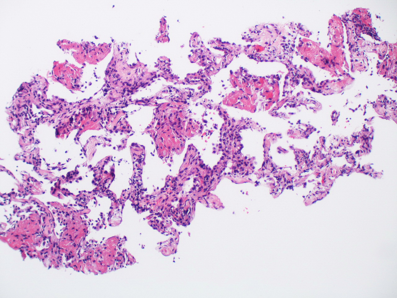 Pneumonia