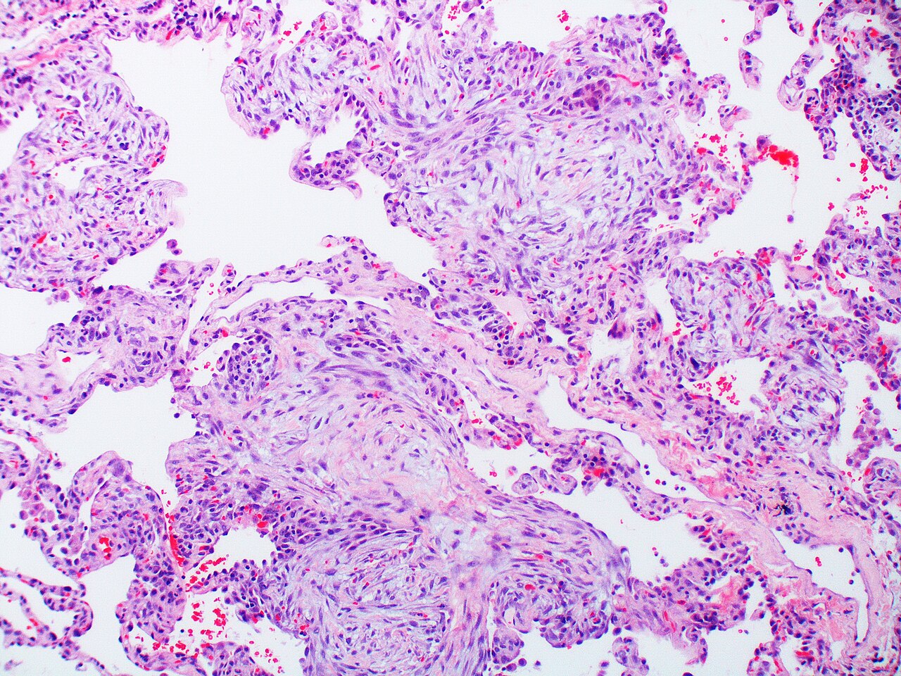Pneumonia
