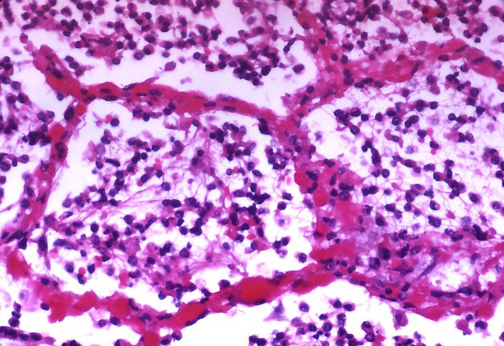 Pneumonia