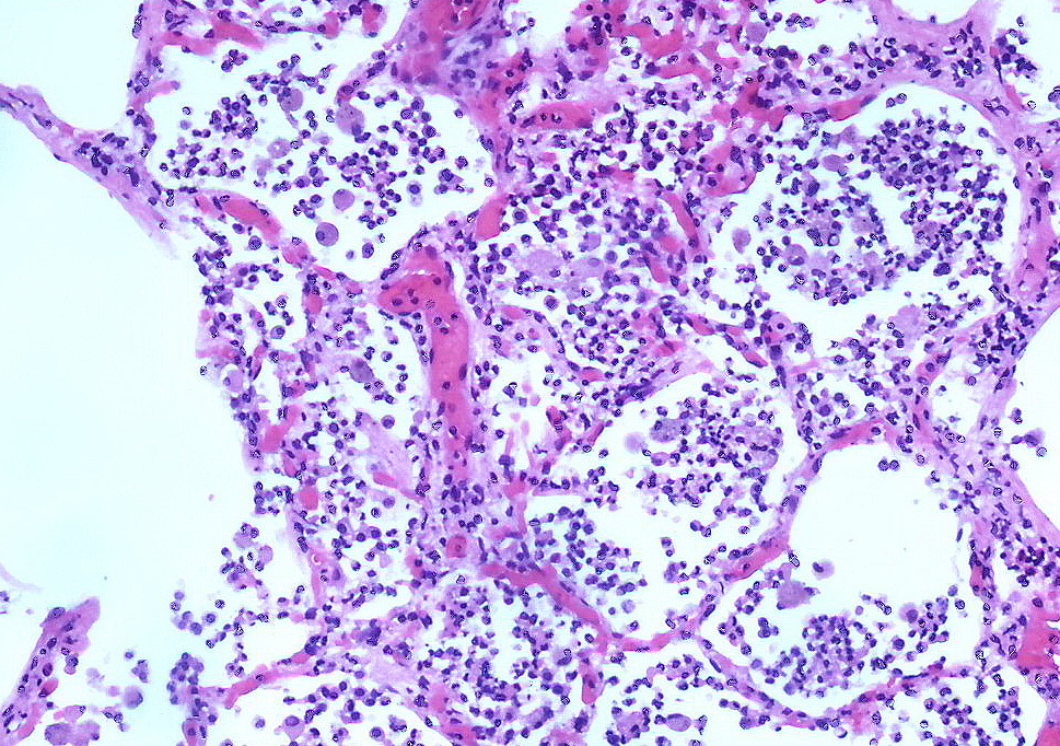 Pneumonia