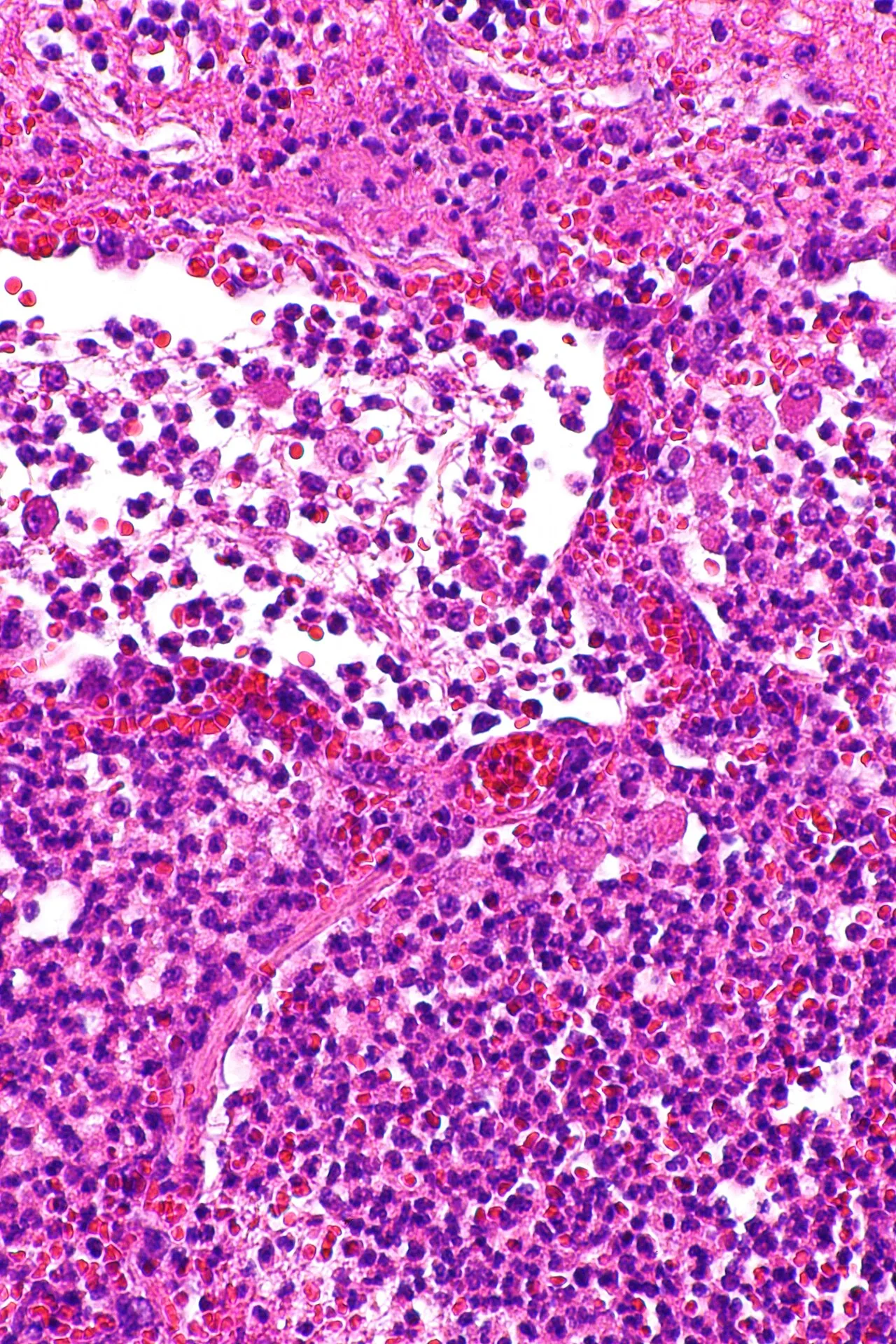 Pneumonia