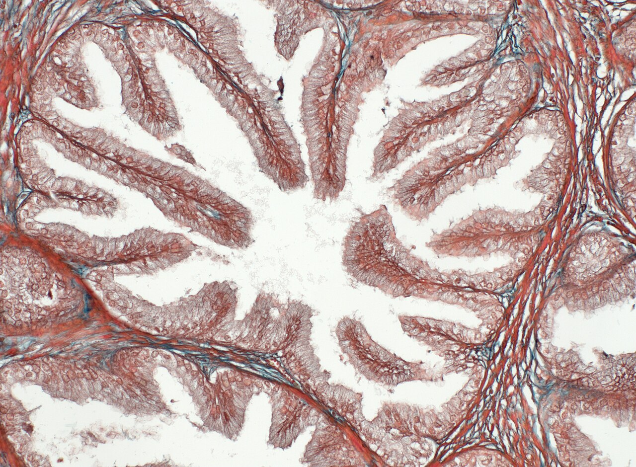 Prostate cancer