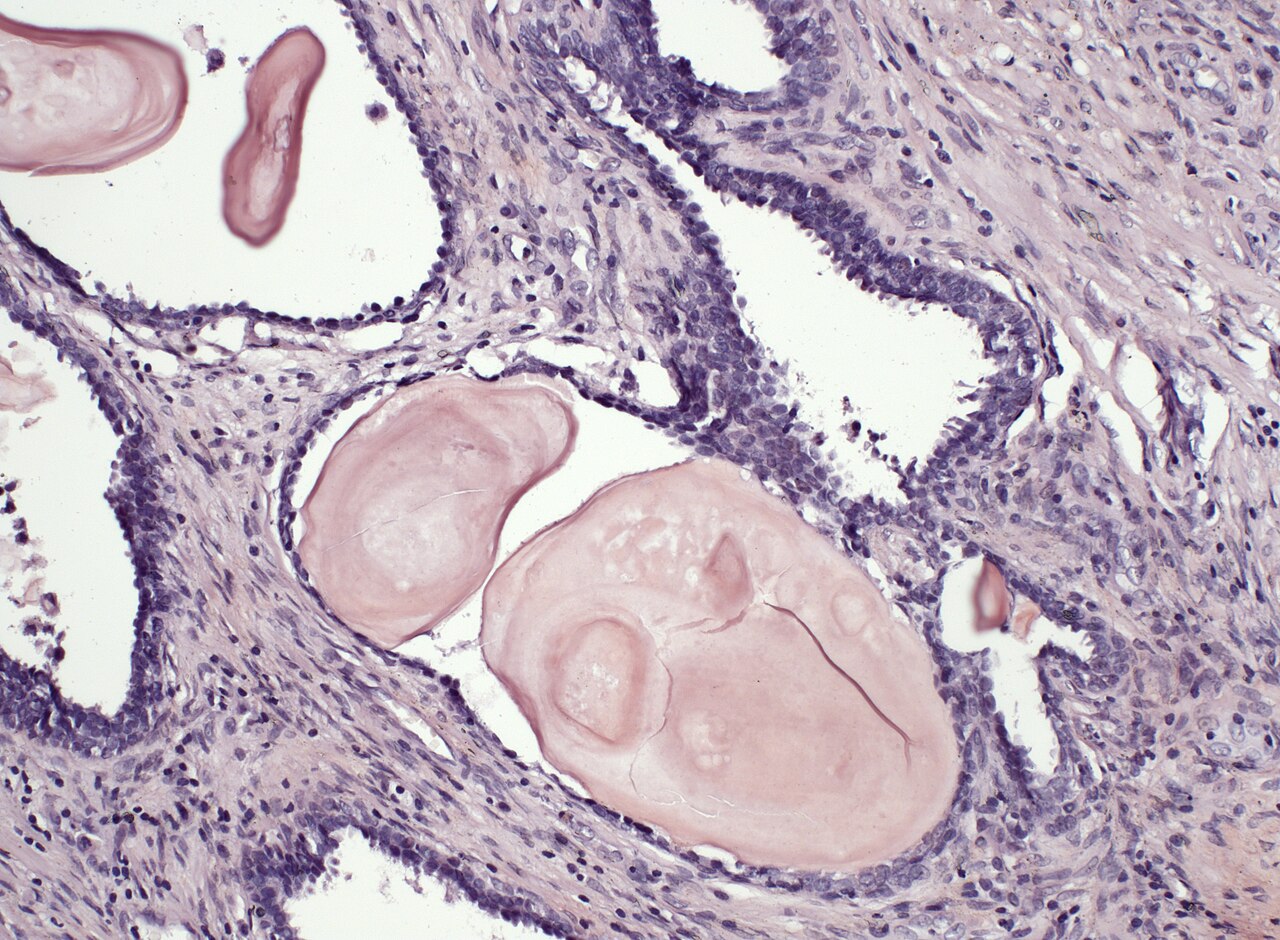 Prostate cancer