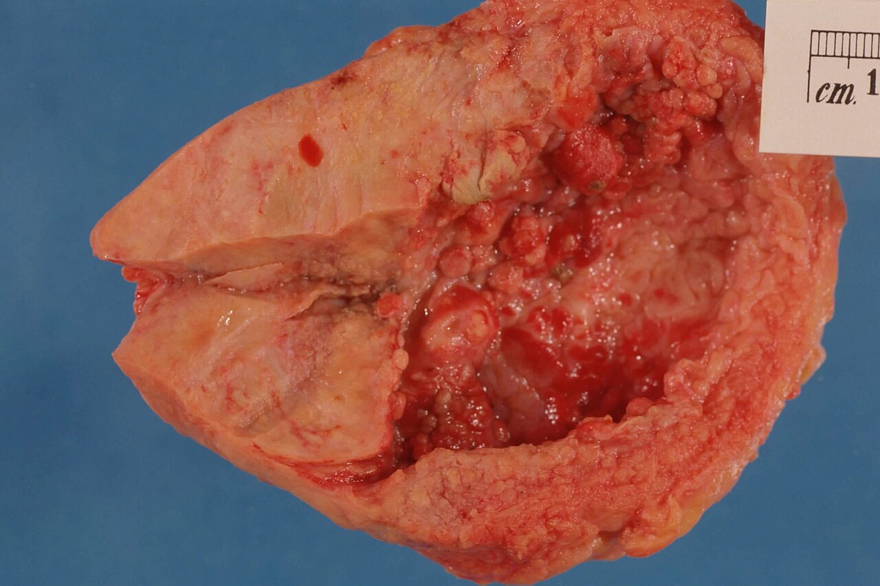 Prostate cancer