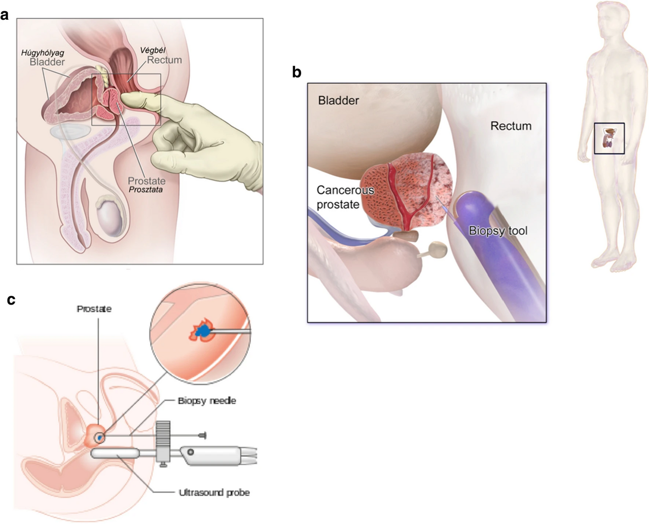 Prostate cancer