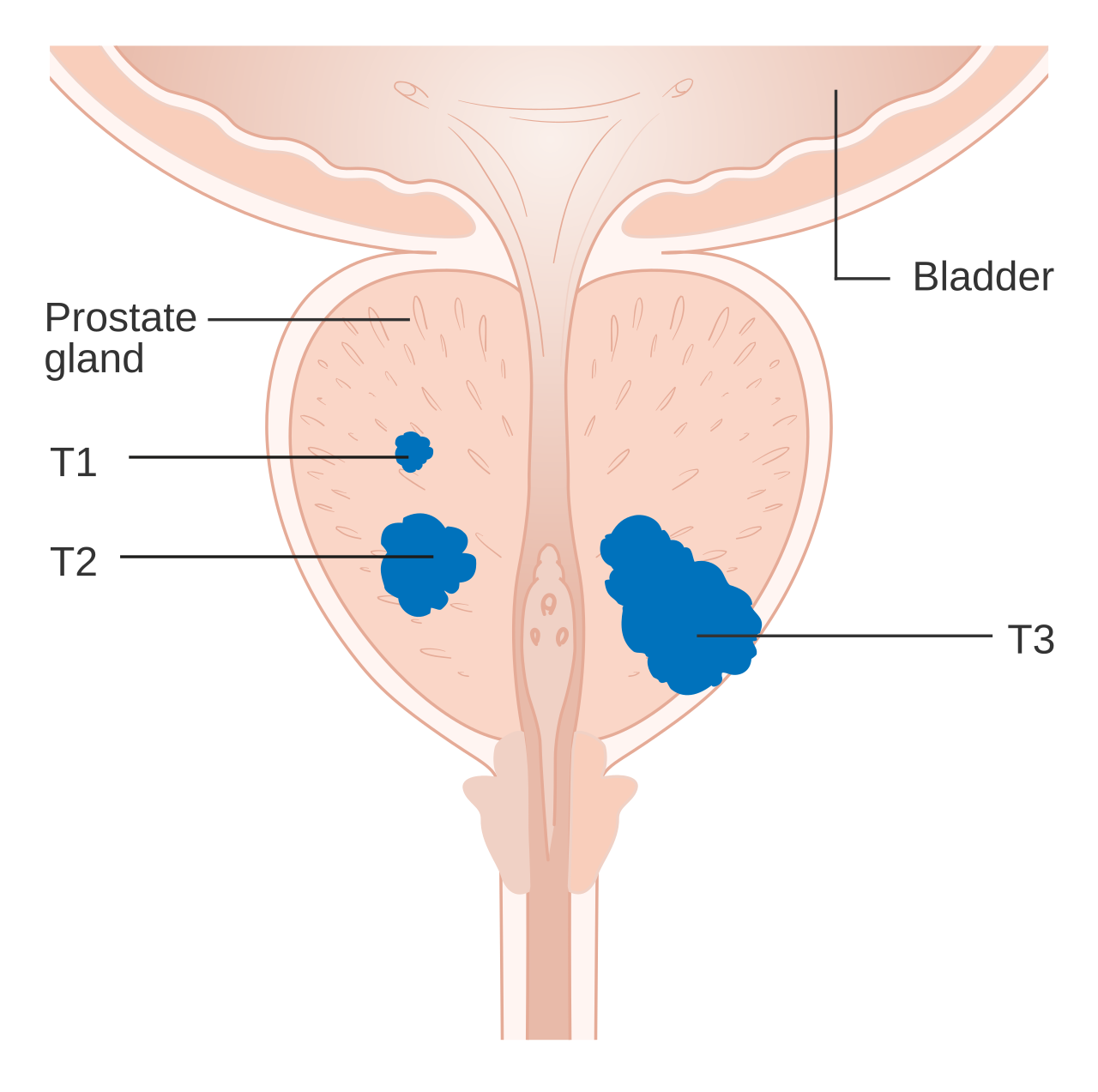 Prostate cancer