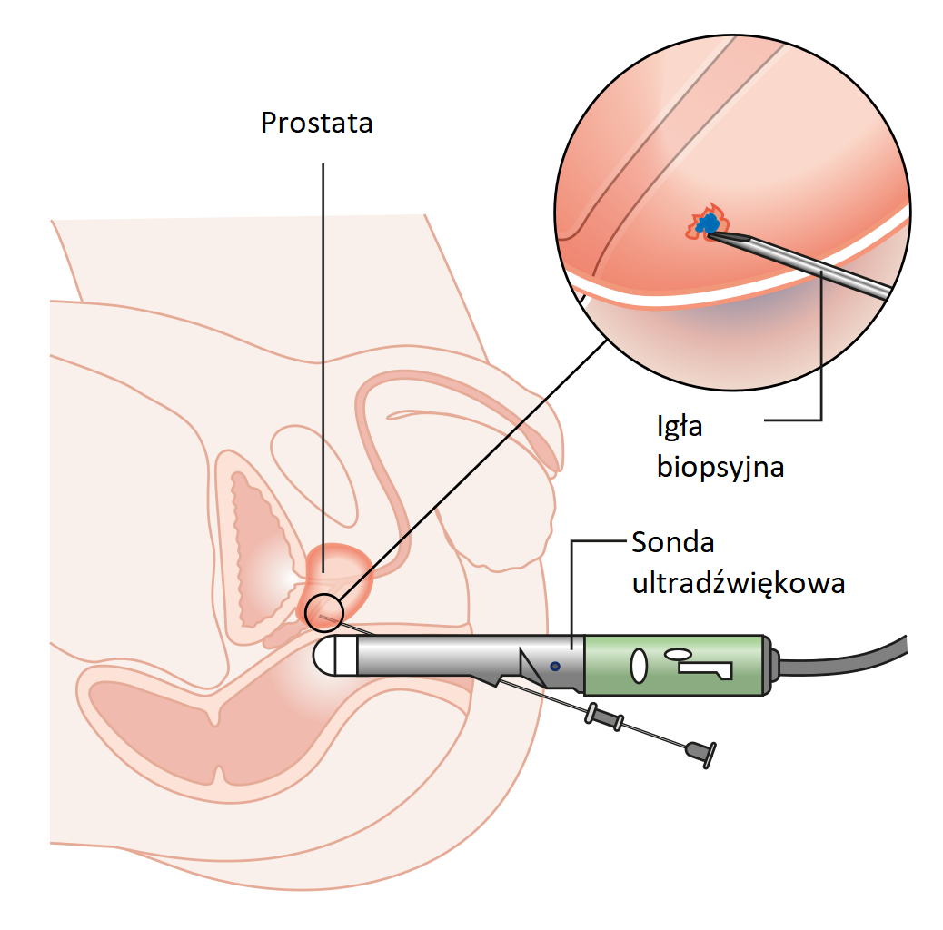 Prostate cancer