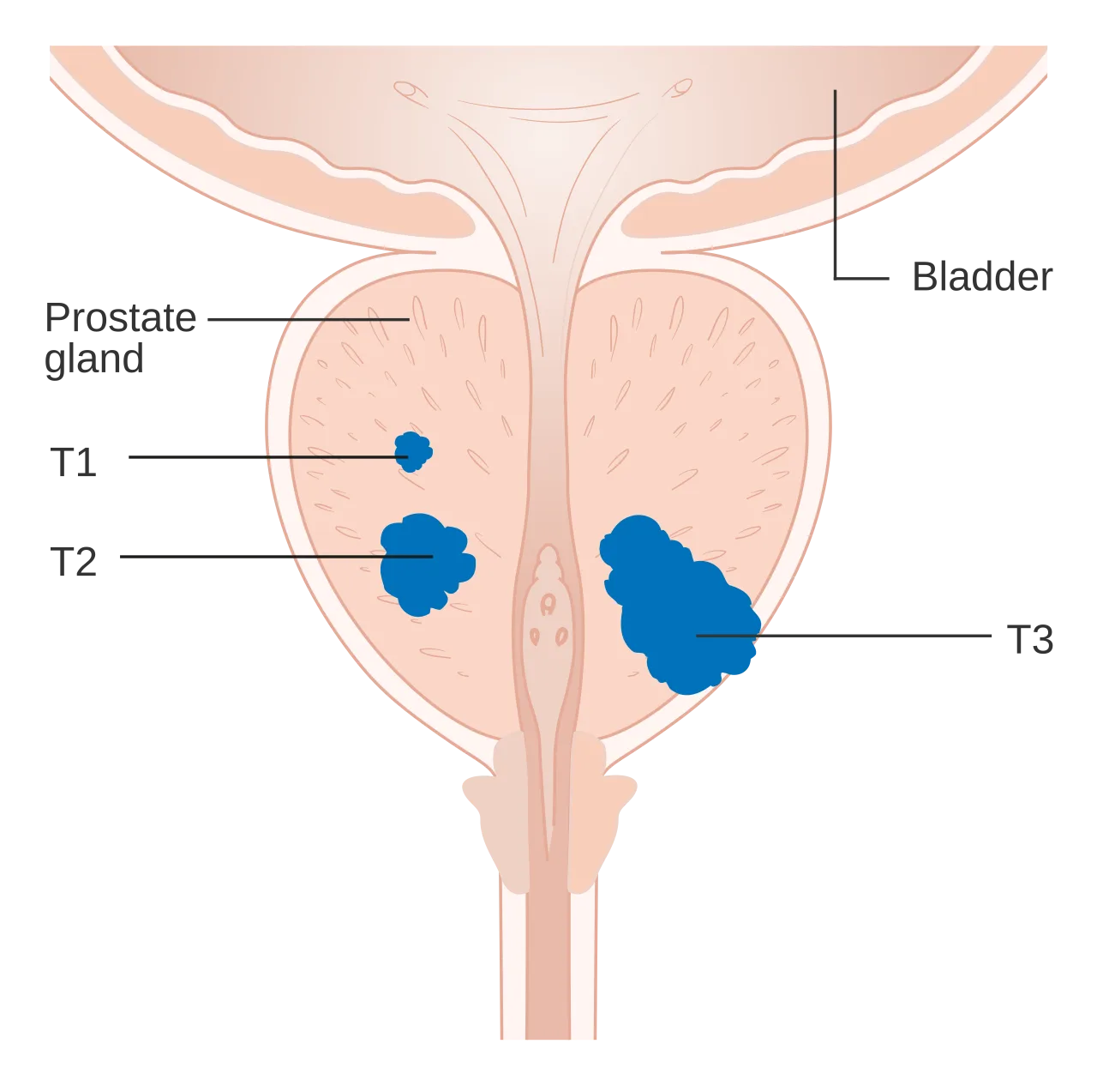Prostate cancer